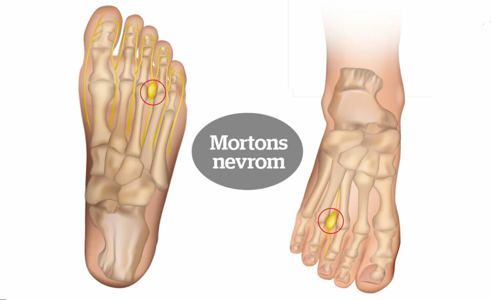 Mortons nevrom: Smertene skyldes en hoven og irritert nerve, som oftest mellom tredje og fjerde tå. (Foto: iStockphoto) Mortons nevrom: Smertene skyldes en hoven og irritert nerve, som oftest mellom tredje og fjerde tå. (Foto: iStockphoto)