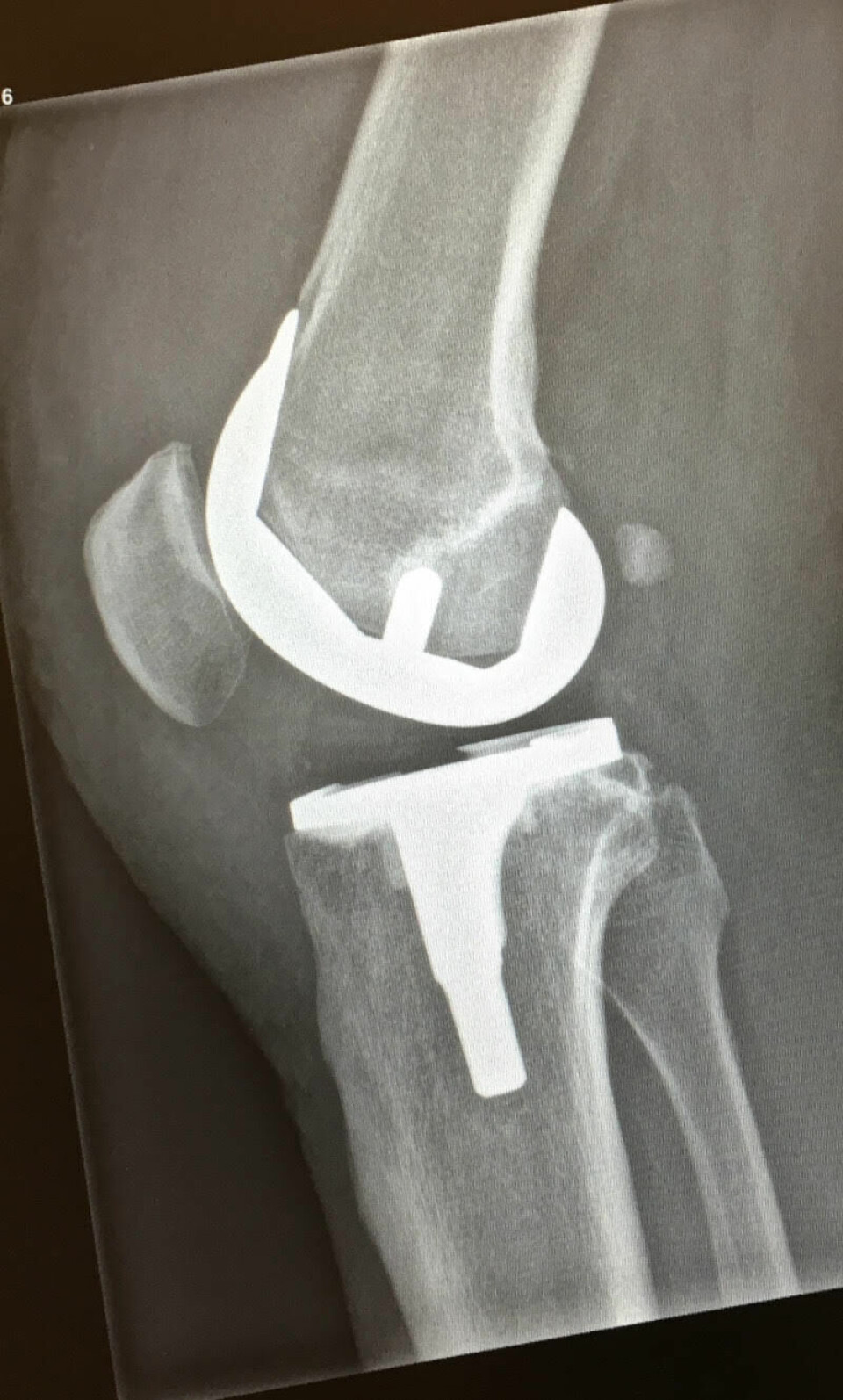Titanman did Ironman! Kneprotese-foto-privat.jpg