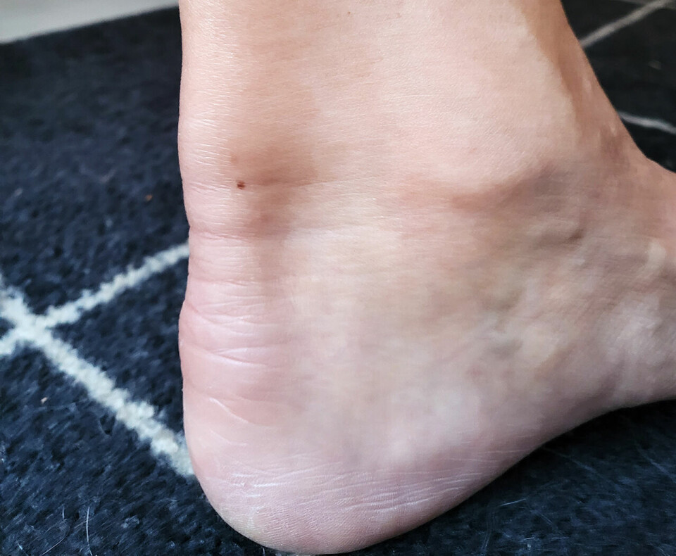 Skade etter karate: Slik ser den vonde akillessenen ut. (Foto: privat) Skade etter karate: Slik ser den vonde akillessenen ut. (Foto: privat)