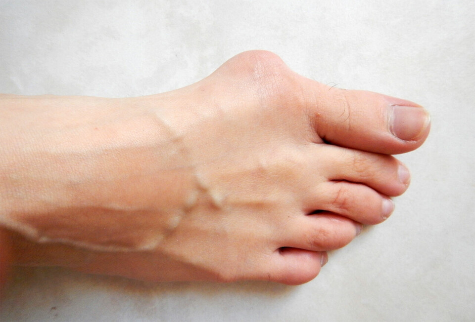 Stortå til besvær: Hallux valgus-plager lar seg vanskelig trene vekk, og om ikke innleggssåler eller romslige sko hjelper, kan operativ behandling vurderes. (Foto: Lamiot, Wikipedia) Stortå til besvær: Hallux valgus-plager lar seg vanskelig trene vekk, og om ikke innleggssåler eller romslige sko hjelper, kan operativ behandling vurderes. (Foto: Lamiot, Wikipedia)